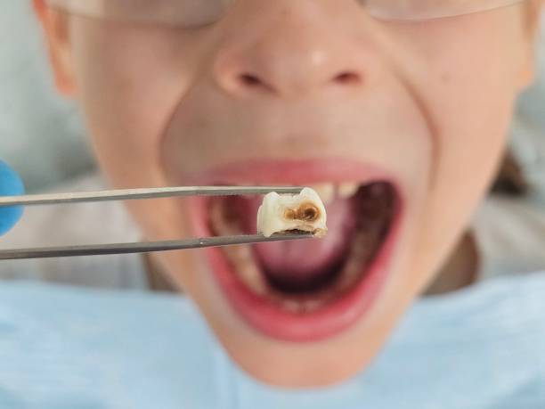 Best Emergency Dentist for Lost Fillings or Crowns in Plattsburgh, NY