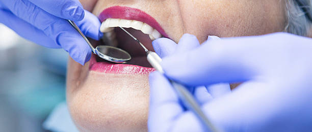 Best Emergency Dentist for Lost Fillings or Crowns in Plattsburgh, NY